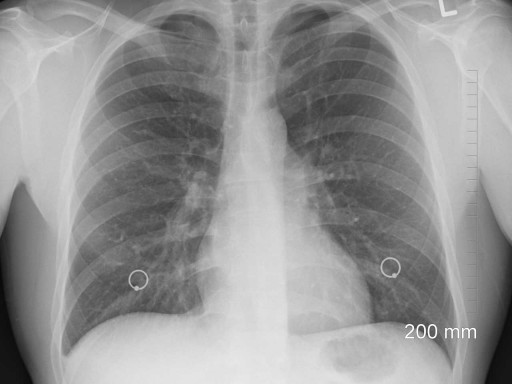 X ray of lungs with possible asbestos poisoning.